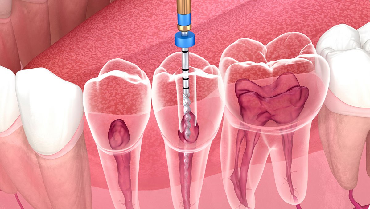 Root Canal Treatment